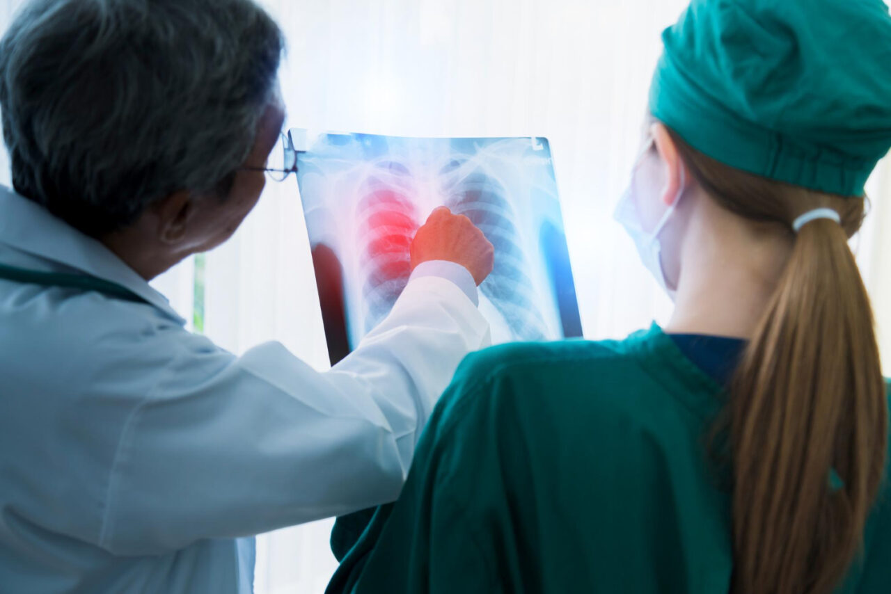 How Immunotherapy is Transforming Lung Cancer Treatment - Dendritic ...